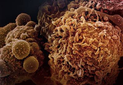 Novel Coronavirus SARS-CoV-2 (Omicron) Colorized scanning electron micrograph