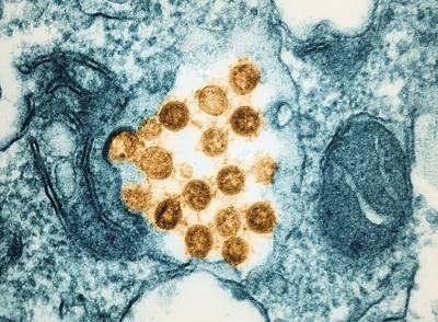 Novel Coronavirus SARS-CoV-2 (Omicron) Transmission electron micrograph of